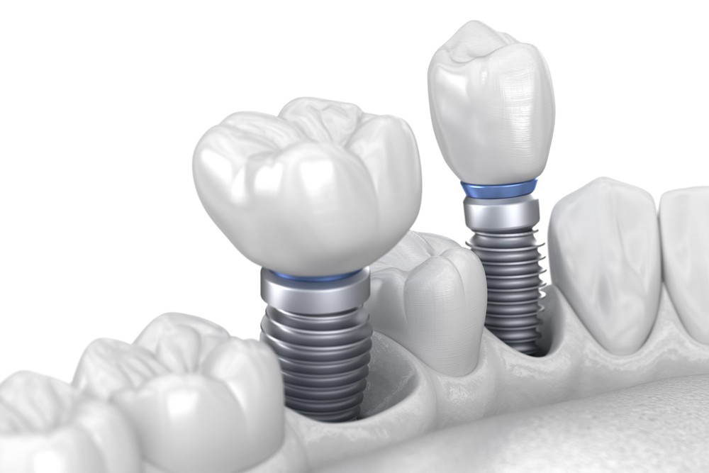 4 Factors To Consider When Ge¬tting All-On-4 Dental Implants
