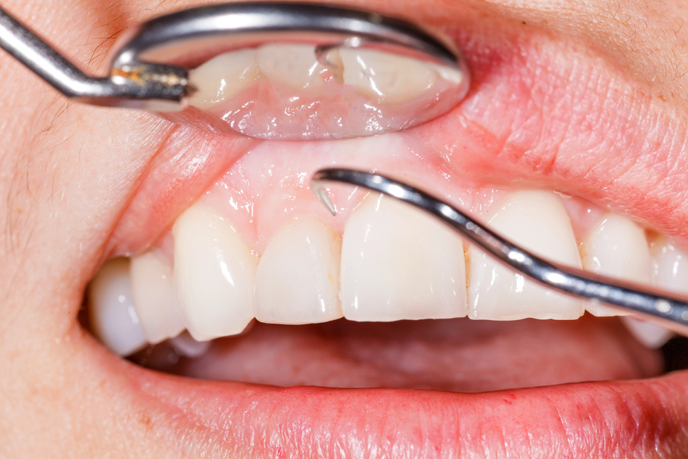 Can You Get Dental Implants With Gum Disease?
